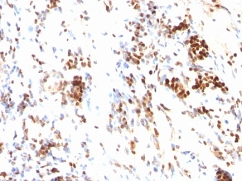 CDKN1B / p27 Kip1 Antibody - Formalin-fixed, paraffin-embedded human colon carcinoma stained with p27 antibody (DCS-72.F6).  This image was taken for the unmodified form of this product. Other forms have not been tested.