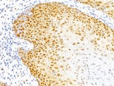 CDKN1B / p27 Kip1 Antibody - Formalin-fixed, paraffin-embedded human cervical cancer stained with p27 antibody (DCS-72.F6).  This image was taken for the unmodified form of this product. Other forms have not been tested.