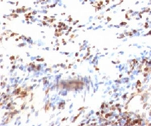 CDKN1B / p27 Kip1 Antibody - Formalin-fixed, paraffin-embedded human colon carcinoma stained with p27Kip1 antibody (KIP1/769).  This image was taken for the unmodified form of this product. Other forms have not been tested.