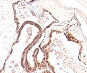 CDKN1B / p27 Kip1 Antibody - Formalin-fixed, paraffin-embedded human prostate cancer stained with p27Kip1 antibody (KIP1/769).  This image was taken for the unmodified form of this product. Other forms have not been tested.