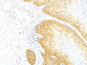 CDKN1B / p27 Kip1 Antibody - Formalin-fixed, paraffin-embedded human cervical cancer stained with p27Kip1 antibody (KIP1/769).  This image was taken for the unmodified form of this product. Other forms have not been tested.