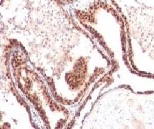 CDKN1B / p27 Kip1 Antibody - IHC testing of FFPE human prostate cancer and p27Kip1 antibody (clone KIP27-1).  This image was taken for the unmodified form of this product. Other forms have not been tested.