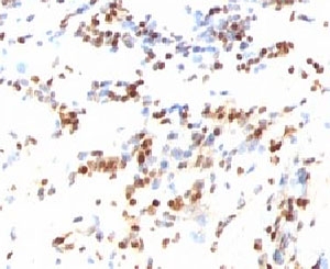 CDKN1B / p27 Kip1 Antibody - IHC testing of FFPE human colon carcinoma and p27Kip1 antibody (clone KIP27-1).  This image was taken for the unmodified form of this product. Other forms have not been tested.