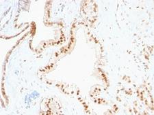 CDKN1B / p27 Kip1 Antibody - Formalin-fixed, paraffin-embedded human prostate carcinoma stained with p27 antibody (SPM348).  This image was taken for the unmodified form of this product. Other forms have not been tested.