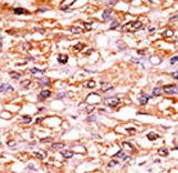 CDKN1B / p27 Kip1 Antibody - Formalin-fixed and paraffin-embedded human cancer tissue reacted with the primary antibody, which was peroxidase-conjugated to the secondary antibody, followed by AEC staining. This data demonstrates the use of this antibody for immunohistochemistry; clinical relevance has not been evaluated. BC = breast carcinoma; HC = hepatocarcinoma.