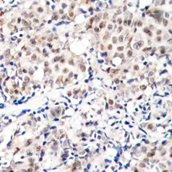 CDKN1B / p27 Kip1 Antibody - Immunohistochemistry of paraffin-embedded human breast carcinoma tissue.