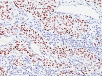 CDKN1C / p57 Kip2 Antibody - Formalin-fixed, paraffin-embedded human bladder carcinoma stained with p57 antibody (57P06).  This image was taken for the unmodified form of this product. Other forms have not been tested.