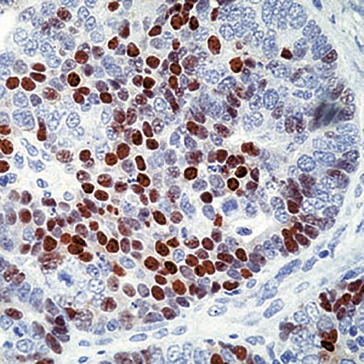 CDKN1C / p57 Kip2 Antibody - Formalin-fixed, paraffin-embedded human colon carcinoma stained with p57Kip2 antibody.