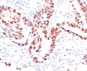 CDKN1C / p57 Kip2 Antibody - Formalin-fixed, paraffin-embedded human colon carcinoma stained with p57 antibody (KIP2/880).  This image was taken for the unmodified form of this product. Other forms have not been tested.