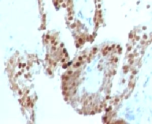 CDKN1C / p57 Kip2 Antibody - IHC testing of human prostate carcinoma and p57 antibody (clone KIP57-1).  This image was taken for the unmodified form of this product. Other forms have not been tested.
