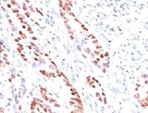 CDKN1C / p57 Kip2 Antibody - IHC testing of human colon carcinoma and p57 antibody (clone KIP57-1).  This image was taken for the unmodified form of this product. Other forms have not been tested.