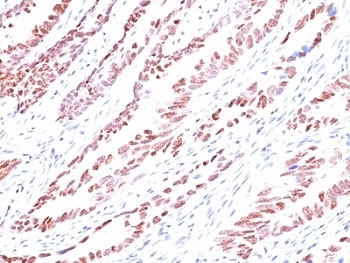 CDKN1C / p57 Kip2 Antibody - Formalin-fixed, paraffin-embedded human colon carcinoma stained with p57 antibody (KP10).  This image was taken for the unmodified form of this product. Other forms have not been tested.