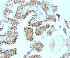 CDKN1C / p57 Kip2 Antibody - Formalin-fixed, paraffin-embedded human prostate carcinoma stained with p57Kip2 antibody (SPM308).  This image was taken for the unmodified form of this product. Other forms have not been tested.