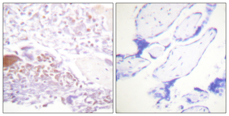 CDKN1C / p57 Kip2 Antibody - Immunohistochemistry analysis of paraffin-embedded human placenta, using p57 Kip2 (Phospho-Thr310) Antibody. The picture on the right is blocked with the phospho peptide.