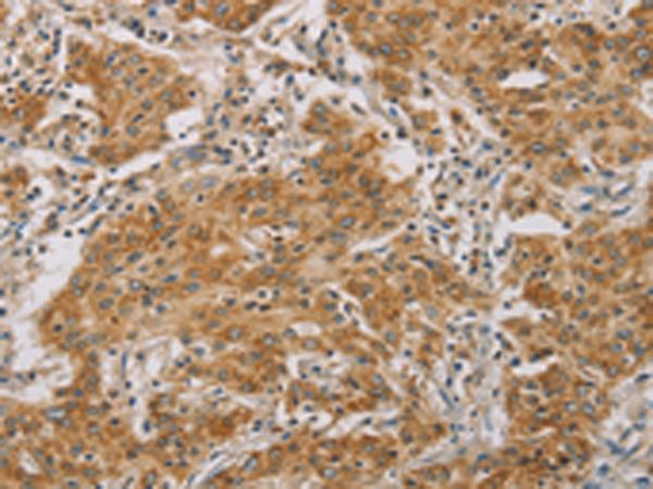 CDKN2A Antibody - Immunohistochemistry of paraffin-embedded Human gasrtic cancer tissue  using CDKN2A Polyclonal Antibody at dilution of 1:50(×200)