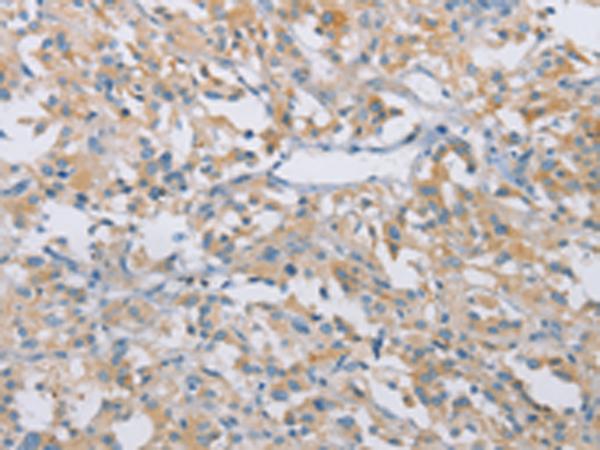 CDKN2A Antibody - Immunohistochemistry of paraffin-embedded Human thyroid cancer tissue  using CDKN2A Polyclonal Antibody at dilution of 1:50(×200)