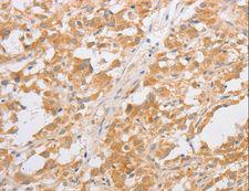 CDKN2AIP Antibody - Immunohistochemistry of paraffin-embedded Human thyroid cancer using CDKN2AIP Polyclonal Antibody at dilution of 1:40.