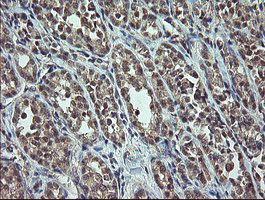 CDKN2B / p15 INK4b Antibody - IHC of paraffin-embedded Carcinoma of Human thyroid tissue using anti-CDKN2B mouse monoclonal antibody.
