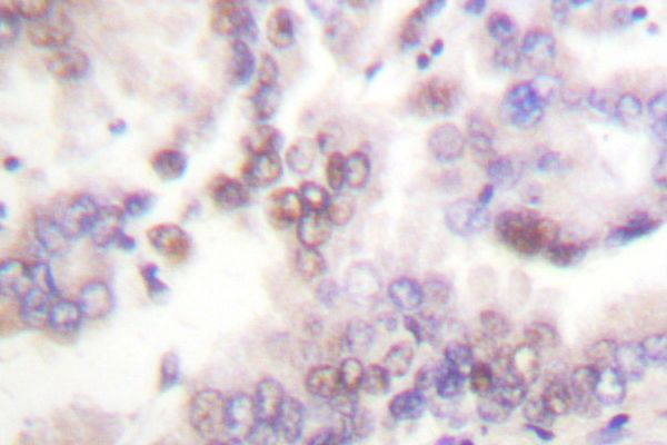 CDKN2B / p15 INK4b Antibody - IHC of p15 INK (G113) pAb in paraffin-embedded human lung carcinoma tissue.