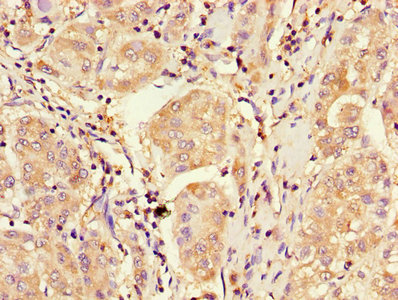 CDKN2B / p15 INK4b Antibody - Immunohistochemistry of paraffin-embedded human liver cancer using CDKN2B Antibody at dilution of 1:100