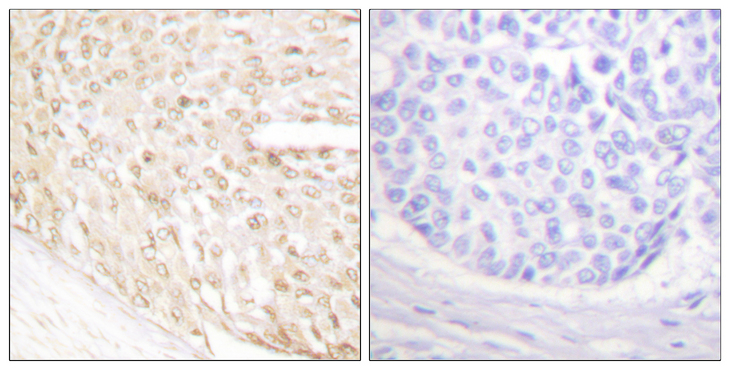 CDKN2C / p18 INK4c Antibody - Immunohistochemistry analysis of paraffin-embedded human breast carcinoma tissue, using p18 INK Antibody. The picture on the right is blocked with the synthesized peptide.