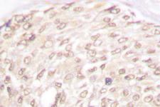 CDKN2C / p18 INK4c Antibody - IHC of p18 INK (D142) pAb in paraffin-embedded human breast carcinoma tissue.