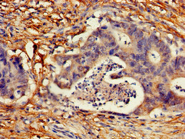 CDKN2C / p18 INK4c Antibody - Immunohistochemistry of paraffin-embedded human colon cancer using CDKN2C Antibody at dilution of 1:100