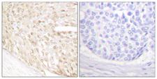 CDKN2C / p18 INK4c Antibody - Peptide - + Immunohistochemical analysis of paraffin-embedded human breast carcinoma tissue using p18 INK antibody.