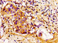 CDKN3 / KAP Antibody - Immunohistochemistry image of paraffin-embedded human breast cancer at a dilution of 1:100