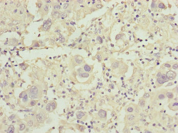 CDO1 / Cysteine Dioxygenase Antibody - Immunohistochemistry of paraffin-embedded human liver cancer at dilution of 1:100