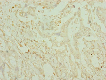 CDO1 / Cysteine Dioxygenase Antibody - Immunohistochemistry of paraffin-embedded human pancreatic cancer at dilution of 1:100