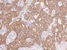 CDON / Cdo Antibody - Immunochemical staining of human CDON in human breast carcinoma with rabbit polyclonal antibody at 1:200 dilution, formalin-fixed paraffin embedded sections.