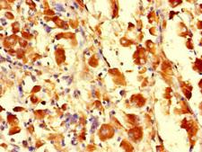 CDS1 Antibody - Immunohistochemistry of paraffin-embedded human melanoma cancer at dilution of 1:100