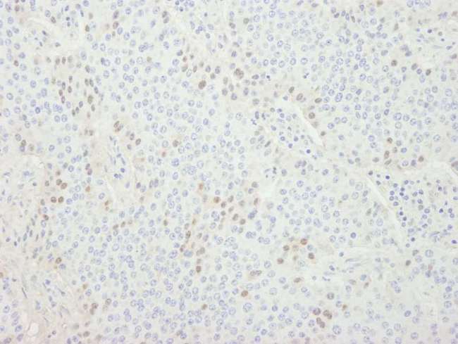 CDT1 Antibody - Detection of Human CDT1 by Immunohistochemistry. Sample: FFPE section of human pancreatic islet cell tumor. Antibody: Affinity purified rabbit anti-CDT1 used at a dilution of 1:250.