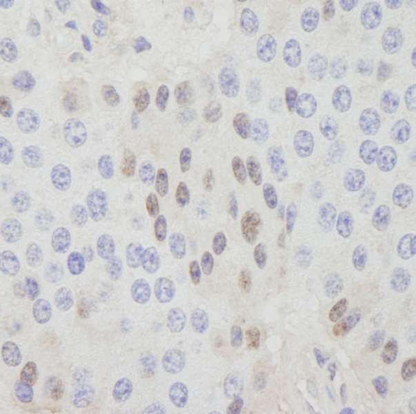 CDT1 Antibody - Detection of Human CDT1 by Immunohistochemistry. Sample: FFPE section of human pancreatic islet cell tumor. Antibody: Affinity purified rabbit anti-CDT1 used at a dilution of 1:250.