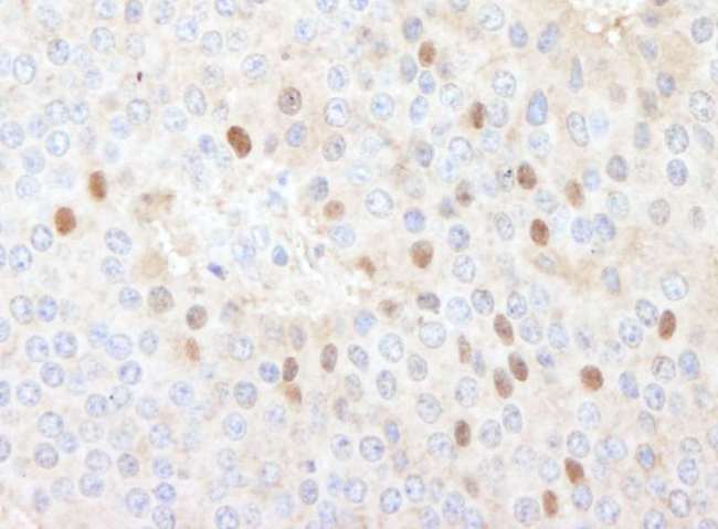 CDT1 Antibody - Detection of Human CDT1 by Immunohistochemistry. Sample: FFPE section of human islet cell carcinoma. Antibody: Affinity purified rabbit anti-CDT` used at a dilution of 1:1000 (1 ug/ml).