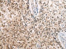 CDT1 Antibody - Immunohistochemistry of paraffin-embedded Human lung cancer tissue  using CDT1 Polyclonal Antibody at dilution of 1:45(×200)