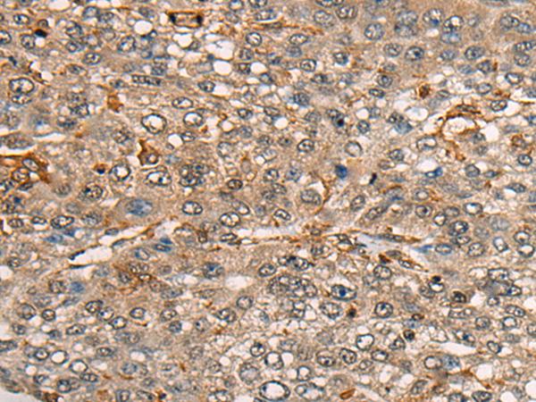 CDT1 Antibody - Immunohistochemistry of paraffin-embedded Human liver cancer tissue  using CDT1 Polyclonal Antibody at dilution of 1:45(×200)