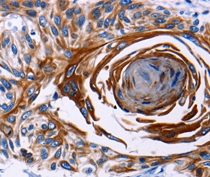 CDw218a / IL18R1 Antibody - Immunohistochemistry of paraffin-embedded human esophagus cancer tissue using IL18R1 antibody.