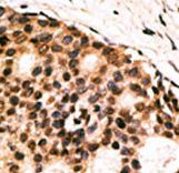 CDX1 Antibody - Formalin-fixed and paraffin-embedded human cancer tissue reacted with the primary antibody, which was peroxidase-conjugated to the secondary antibody, followed by AEC staining. This data demonstrates the use of this antibody for immunohistochemistry; clinical relevance has not been evaluated. BC = breast carcinoma; HC = hepatocarcinoma.