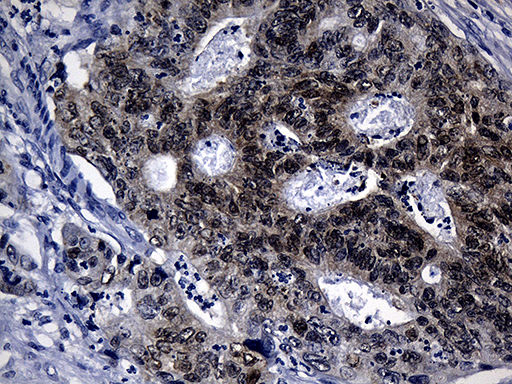CDX1 Antibody - Immunohistochemical staining of paraffin-embedded Adenocarcinoma of Human colon tissue using anti-CDX1 mouse monoclonal antibody. (Heat-induced epitope retrieval by 1mM EDTA in 10mM Tris buffer. (pH8.5) at 120°C for 3 min. (1:500)