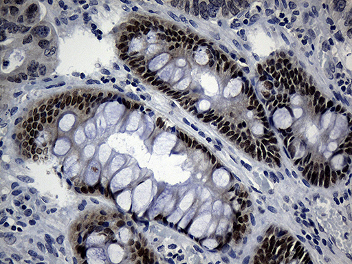 CDX1 Antibody - Immunohistochemical staining of paraffin-embedded Adenocarcinoma of Human colon tissue using anti-CDX1 mouse monoclonal antibody. (Heat-induced epitope retrieval by 1mM EDTA in 10mM Tris buffer. (pH8.5) at 120°C for 3 min. (1:150)