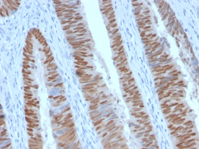 CDX2 Antibody - Formalin-fixed, paraffin-embedded human Colon Carcinoma stained with CDX2 Rabbit Recombinant Monoclonal Antibody (CDX2/2951R).