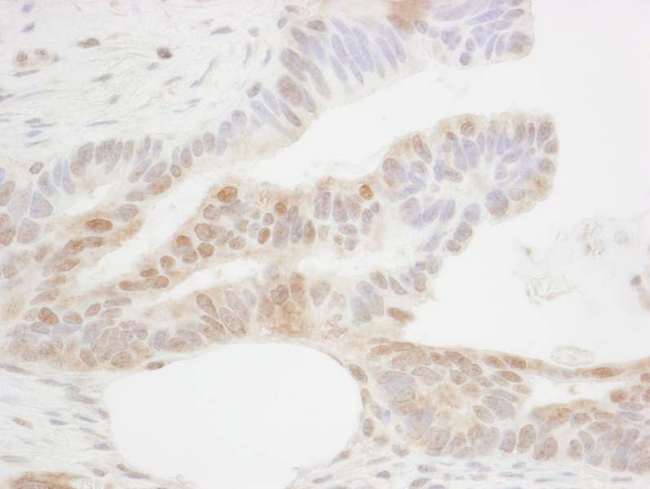 CDX2 Antibody - Detection of Human CDX2 by Immunohistochemistry. Sample: FFPE section of human ovarian carcinoma. Antibody: Affinity purified rabbit anti-CDX2 used at a dilution of 1:1000 (1 ug/ml).