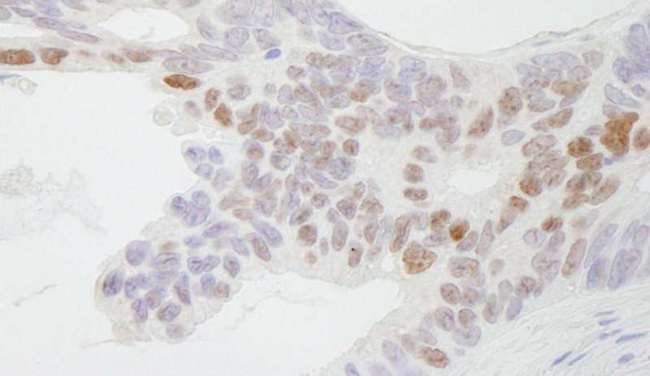CDX2 Antibody - Detection of Human CDX2 by Immunohistochemistry. Sample: FFPE section of human ovarian carcinoma. Antibody: Affinity purified rabbit anti-CDX2 used at a dilution of 1:500.
