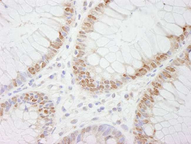CDX2 Antibody - Detection of Human CDX2 by Immunohistochemistry. Sample: FFPE section of human colon. Antibody: Affinity purified rabbit anti-CDX2 used at a dilution of 1:500.