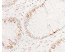 CDX2 Antibody - Detection of Human CDX2 by Immunohistochemistry. Sample: FFPE section of human colon carcinoma. Antibody: Affinity purified rabbit anti-CDX2 used at a dilution of 1:1000 (0.2 ug/ml).