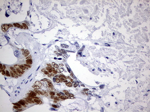 CDX2 Antibody - IHC of paraffin-embedded Adenocarcinoma of Human colon tissue using anti-CDX2 mouse monoclonal antibody. (Heat-induced epitope retrieval by 1 mM EDTA in 10mM Tris, pH9.0, 120°C for 3min).