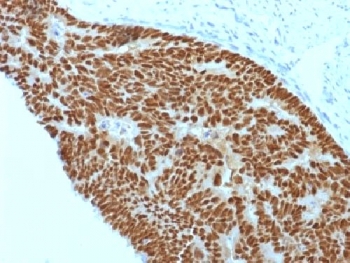 CDX2 Antibody - IHC testing of FFPE human colon carcinoma with CDX2 antibody (clone CDX2/1690). Required HIER: boil sections in 10mM citrate buffer, pH6, for 10-20 min.