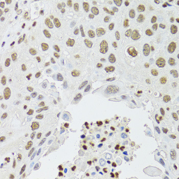 CDX2 Antibody - Immunohistochemistry of paraffin-embedded human lung cancer using CDX2 antibodyat dilution of 1:100 (40x lens).